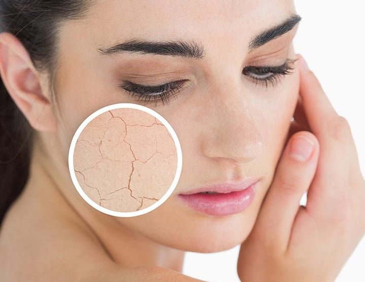 Dry Skin - MY SKIN SPOT
