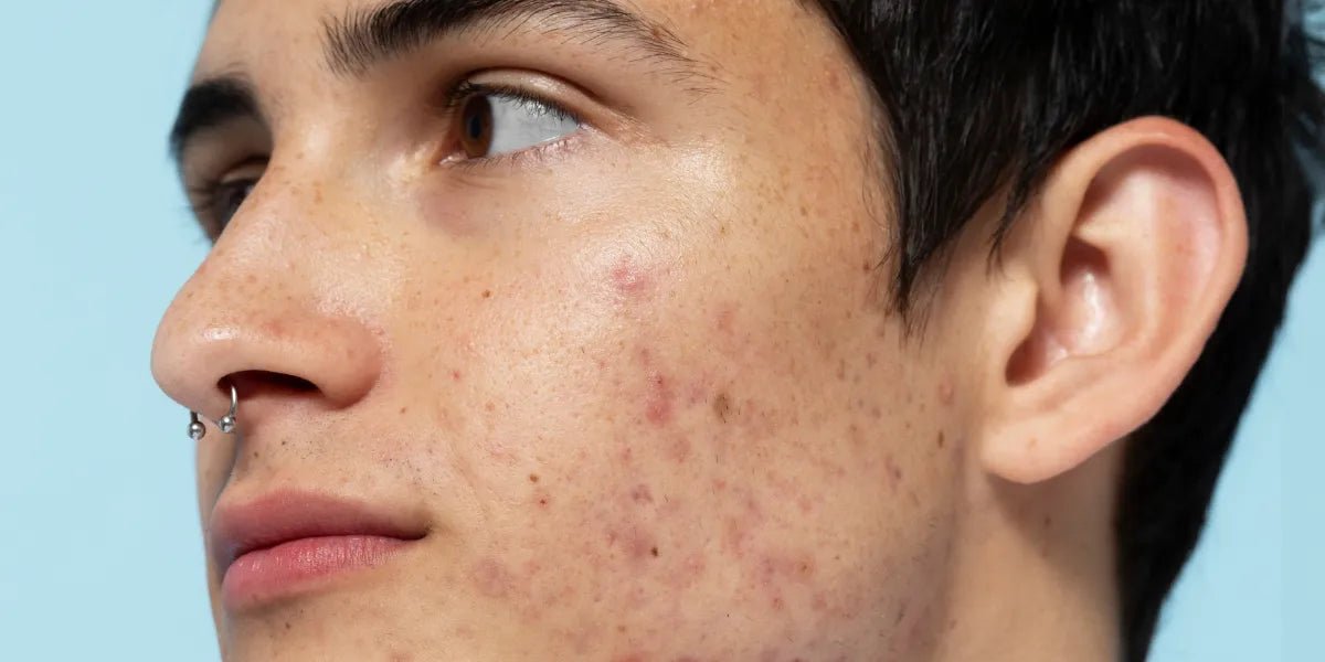 Scar Prevention & Treatment - MY SKIN SPOT