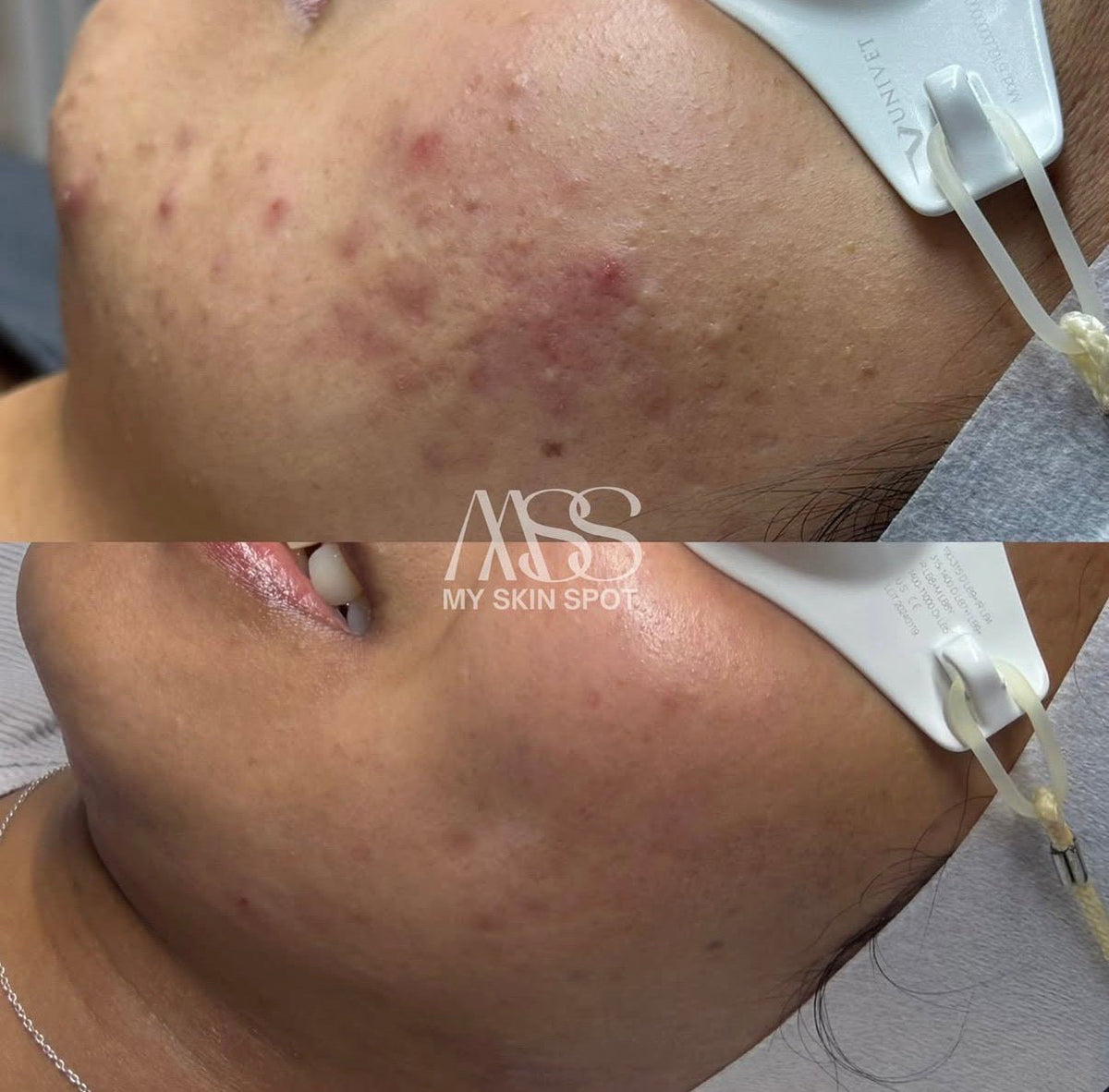 AEROPEEL - Laser + Customized Clinical Peel - MY SKIN SPOT