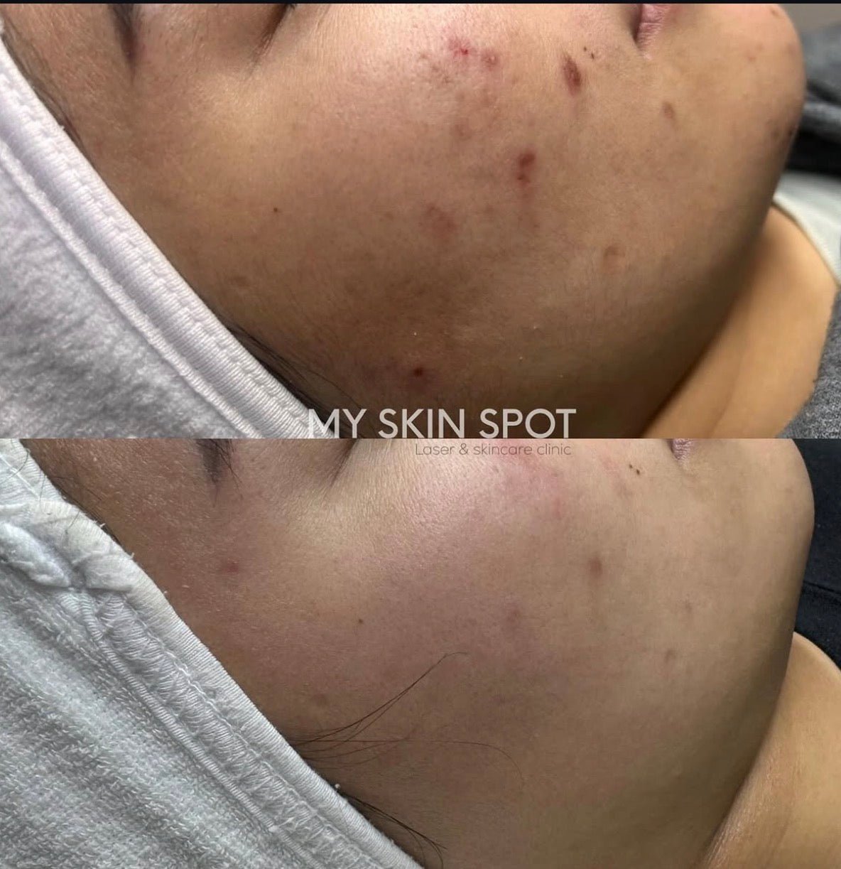 AEROPEEL - Laser + Customized Clinical Peel - MY SKIN SPOT