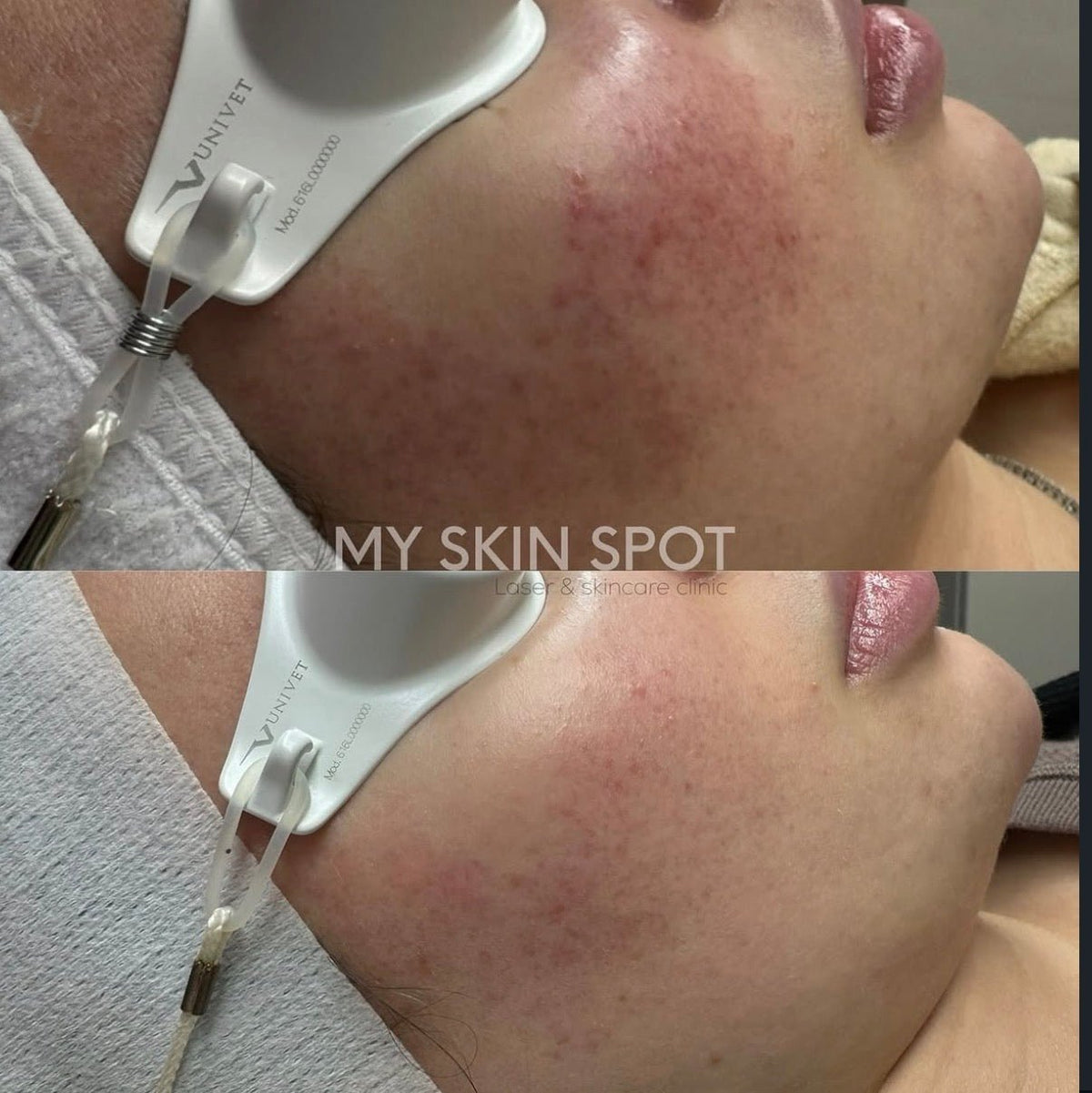 AEROPEEL - Laser + Customized Clinical Peel - MY SKIN SPOT