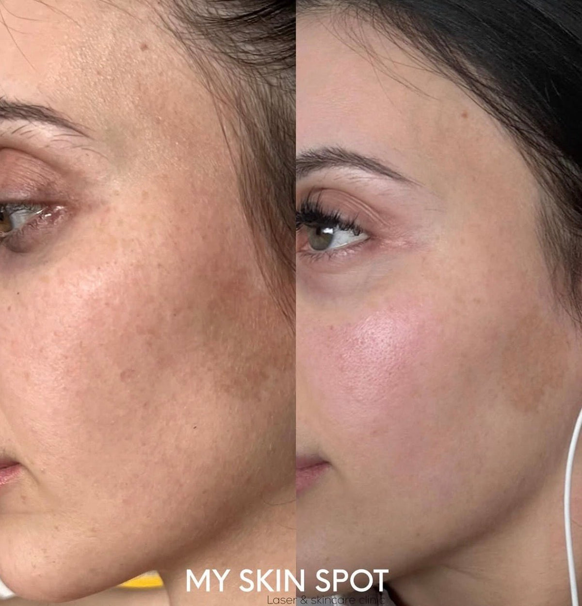AEROPEEL - Laser + Customized Clinical Peel - MY SKIN SPOT