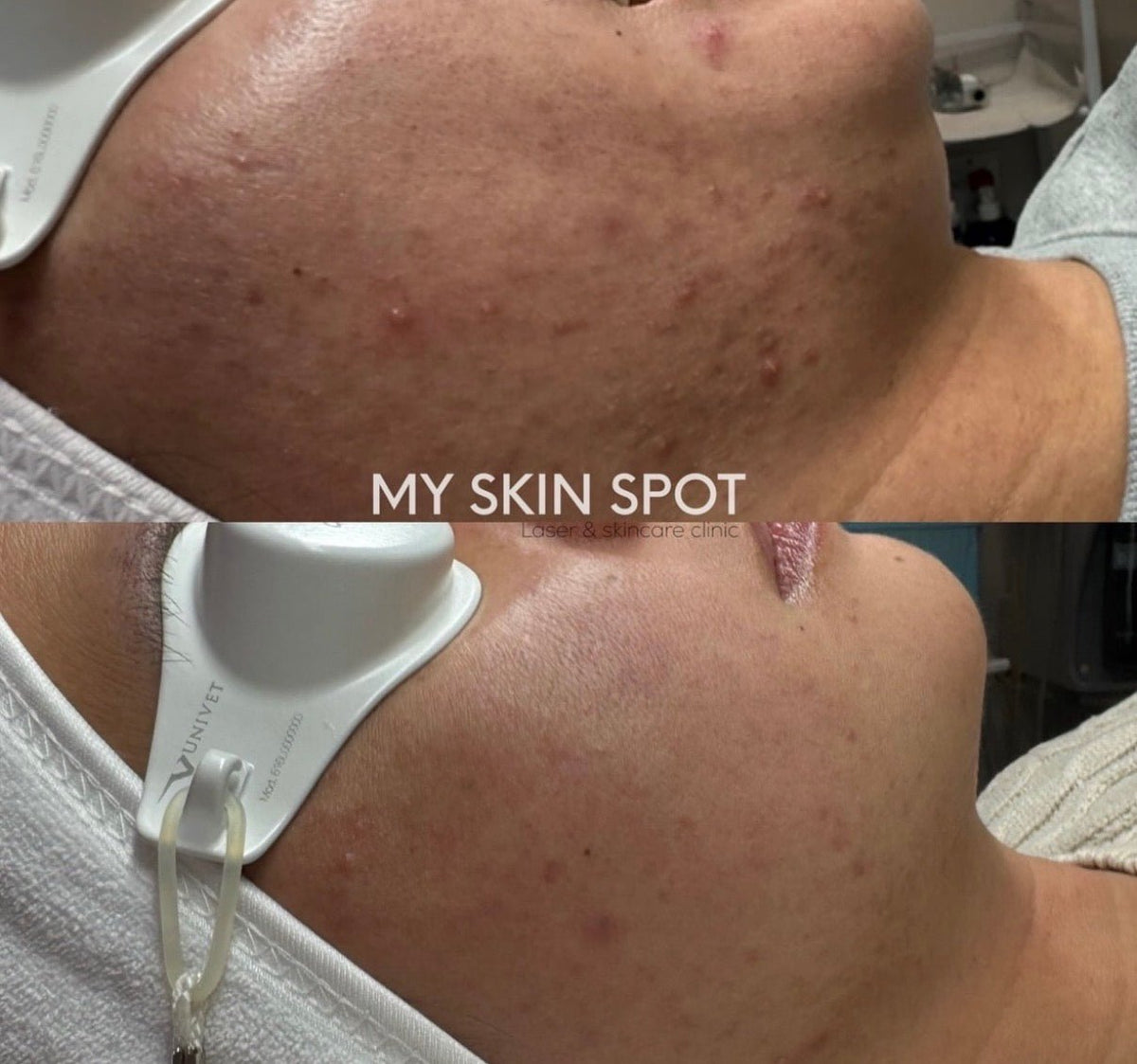 AEROPEEL - Laser + Customized Clinical Peel - MY SKIN SPOT