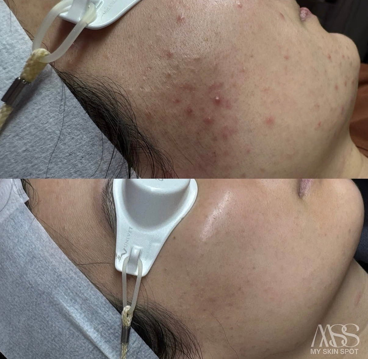 AEROPEEL - Laser + Customized Clinical Peel - MY SKIN SPOT