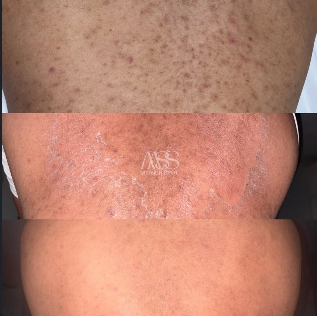 ALGAE PEEL BUY 3 GET 1 FREE - MY SKIN SPOT