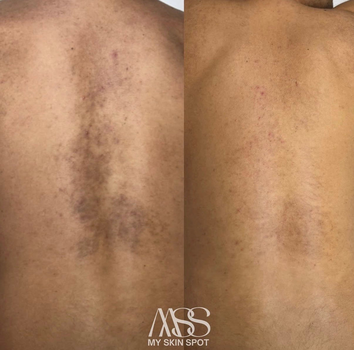 ALGAE PEEL BUY 3 GET 1 FREE - MY SKIN SPOT
