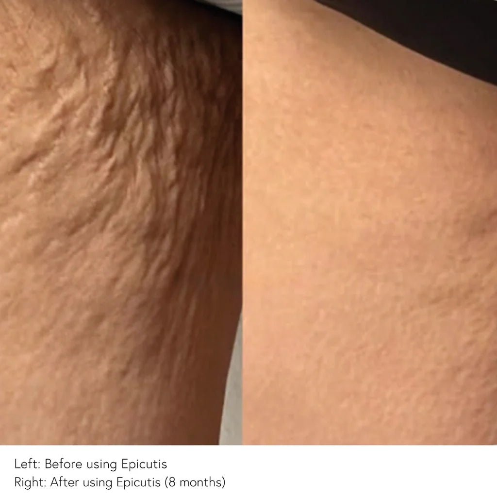 EPICUTIS Lipid Body Treatment - MY SKIN SPOT