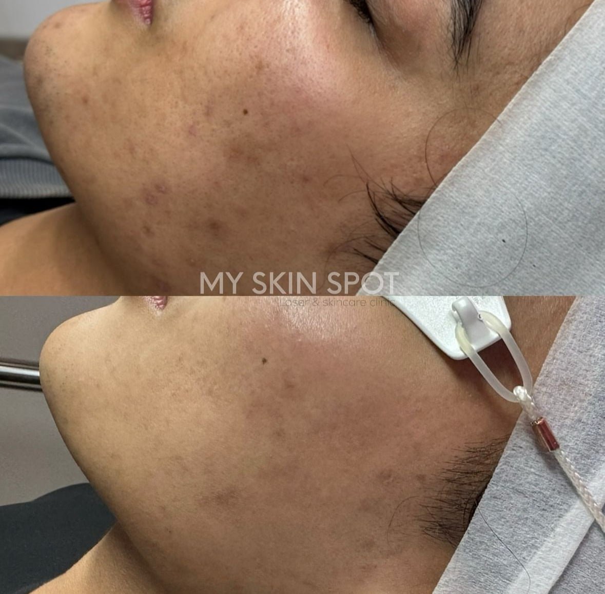 OCTOBER ALGAE PEEL PROMO - MY SKIN SPOT