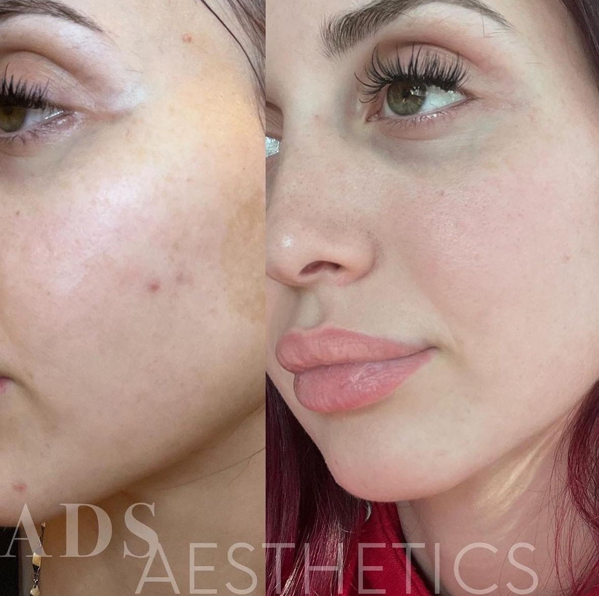 OCTOBER ALGAE PEEL PROMO - MY SKIN SPOT