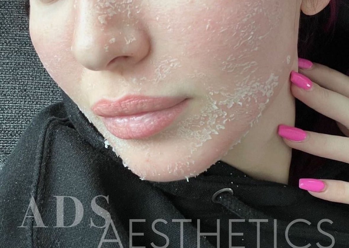 OCTOBER ALGAE PEEL PROMO - MY SKIN SPOT