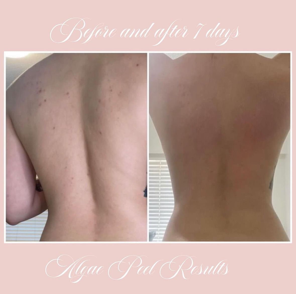 OCTOBER ALGAE PEEL PROMO - MY SKIN SPOT