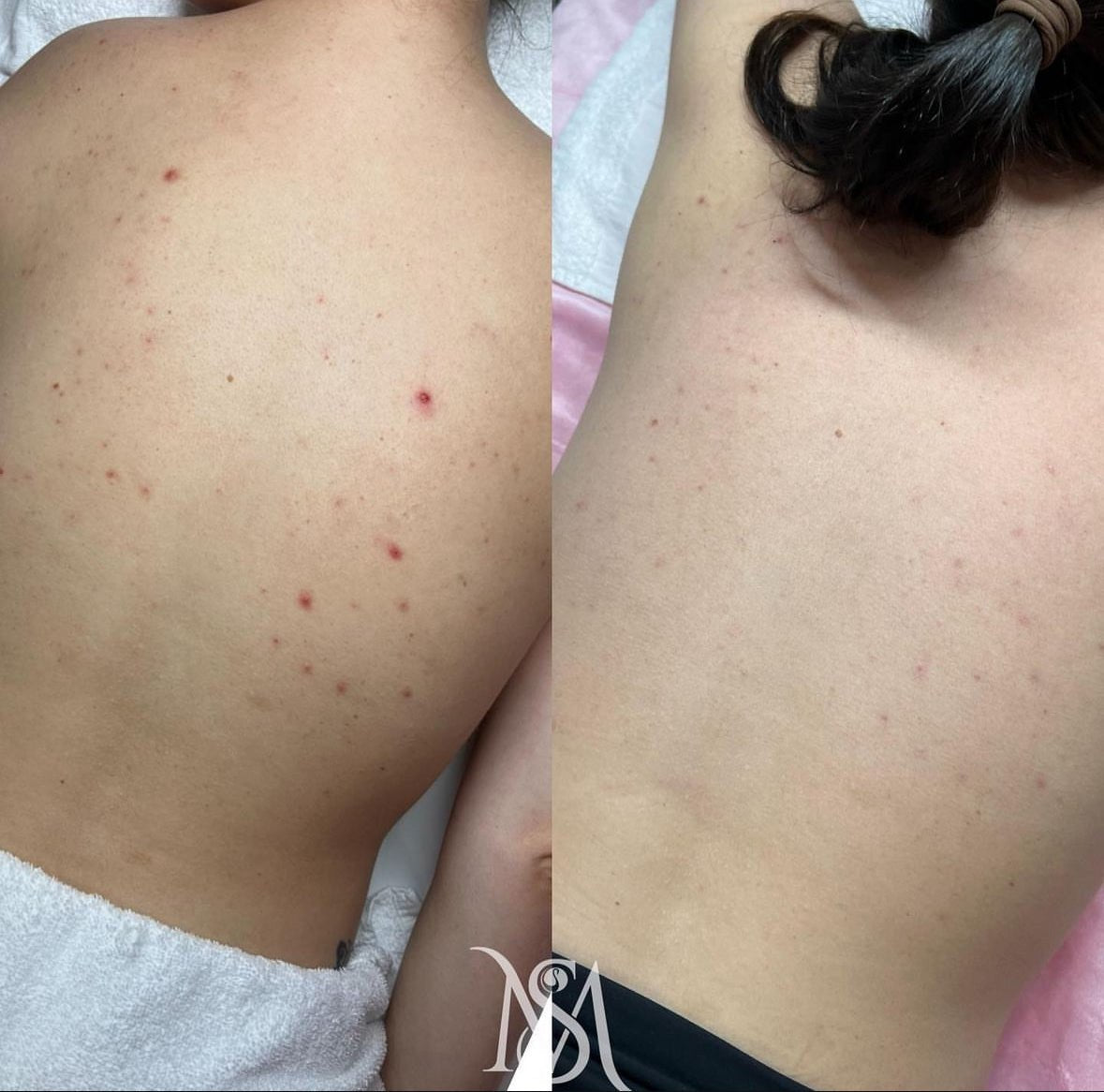 OCTOBER ALGAE PEEL PROMO - MY SKIN SPOT