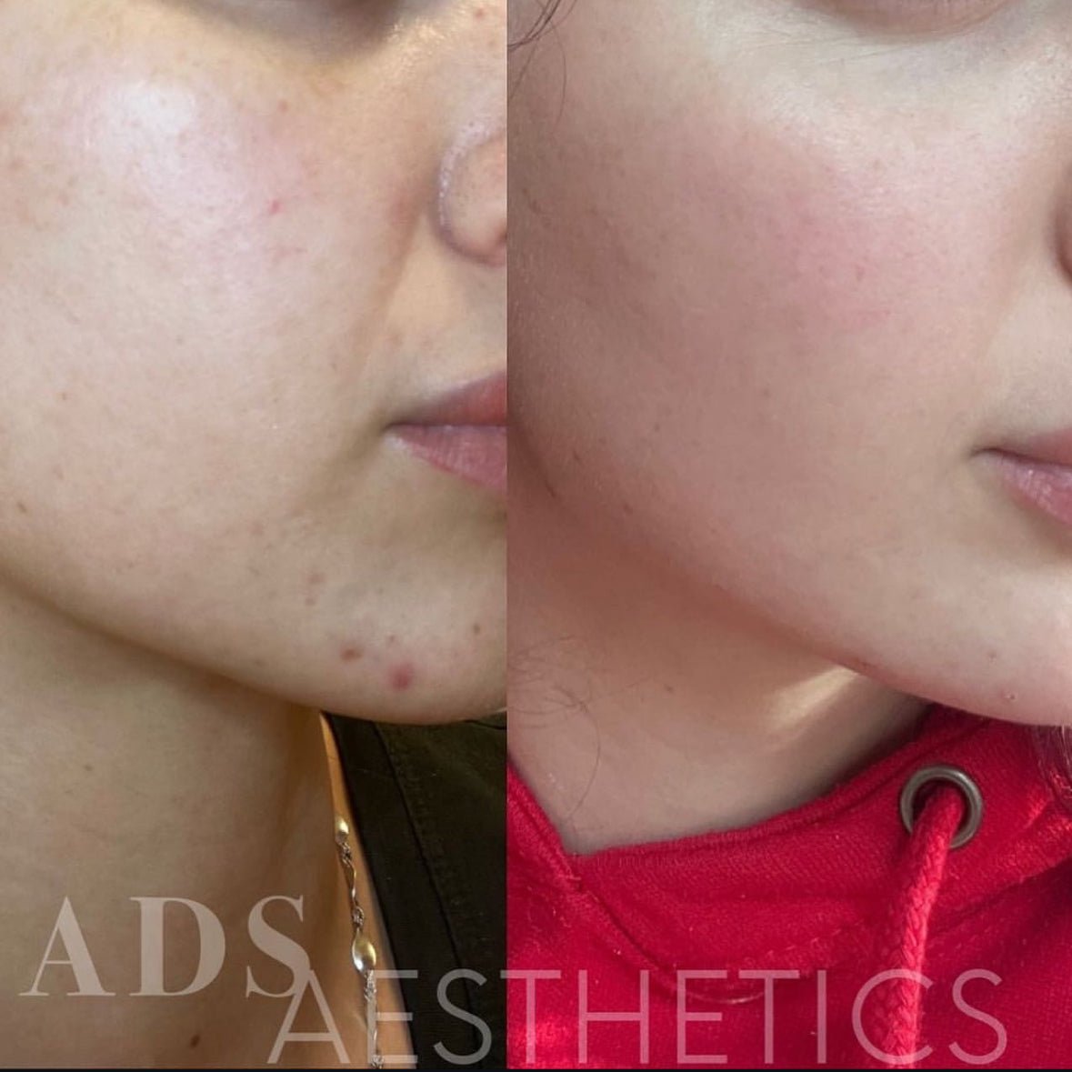 OCTOBER ALGAE PEEL PROMO - MY SKIN SPOT