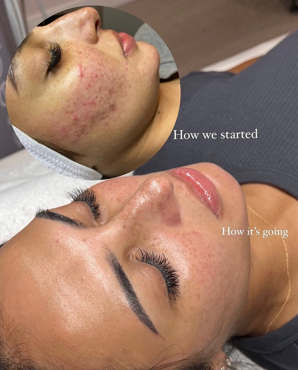 SKIN PEN MICRONEEDLING -Face, Neck Dec - MY SKIN SPOT