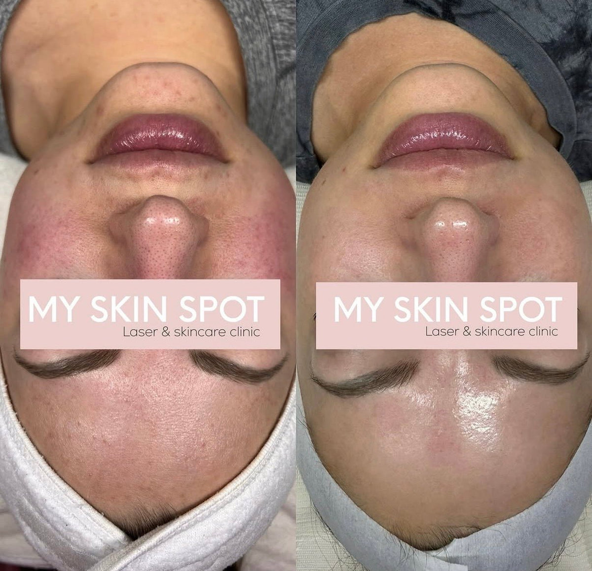 SKIN PEN MICRONEEDLING -Face, Neck Dec - MY SKIN SPOT