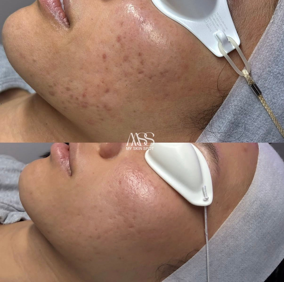 SKIN PEN MICRONEEDLING -Face, Neck Dec - MY SKIN SPOT