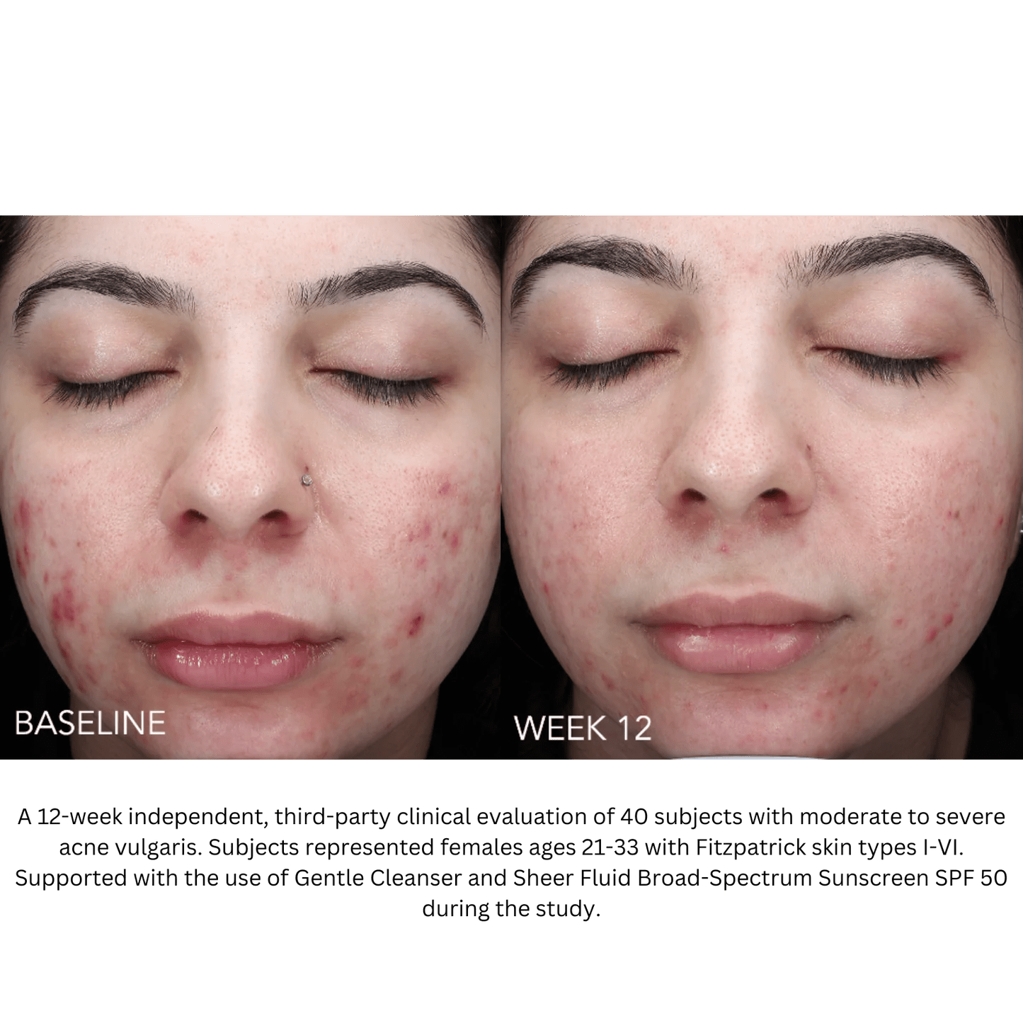 ZO Acne Complex - MY SKIN SPOT